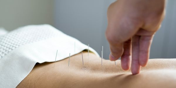 A professional practitioner performing acupuncture on a patient 